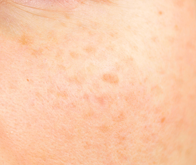 Protect Skin from Environmental Aggressors