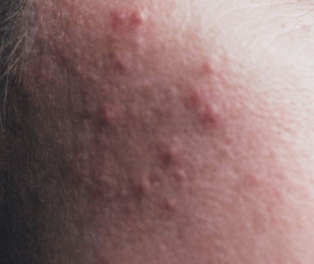 Adult Acne Do’s + Don’ts
