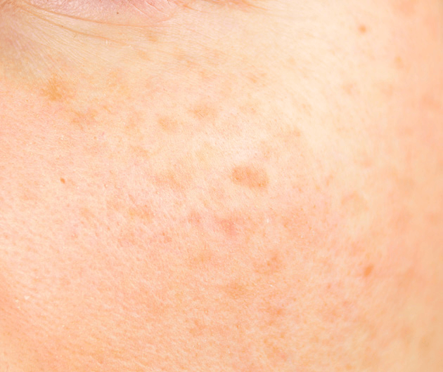 Protect Skin from Environmental Aggressors