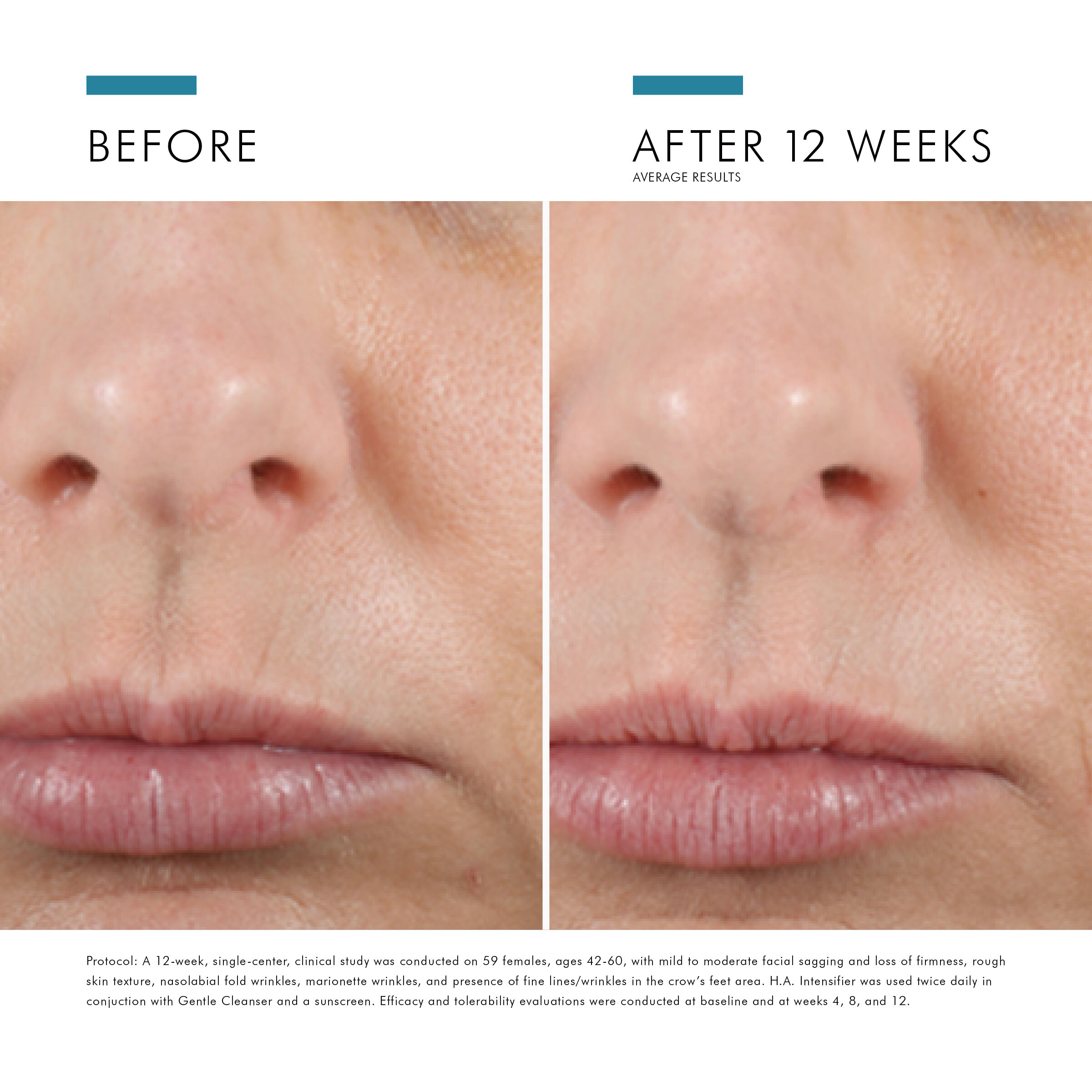 HYALURONIC ACID INTENSIFIER (H.A.)
