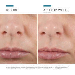 HYALURONIC ACID INTENSIFIER (H.A.)